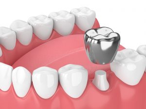 beneficii coroana dentara
